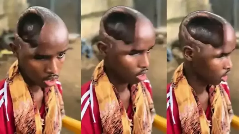 Beyni olmayan adam TikTok videosu gerçek mi?